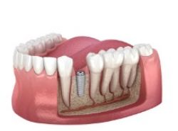 インプラント埋入手術のイラスト