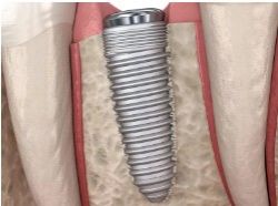 インプラントの拡大イラスト