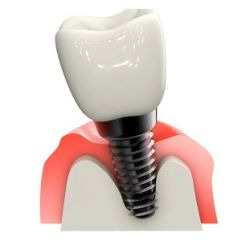 クリーニングしたインプラントのイメージ