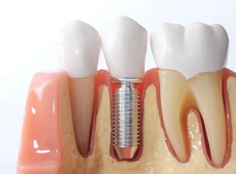 インプラント施術後の断面模型