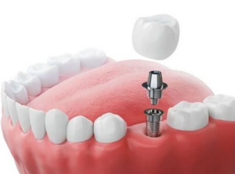 インプラントの施術イメージ