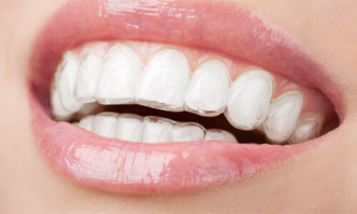 マウスピースを装着している歯