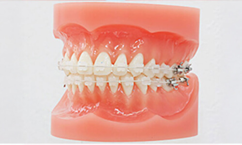 マウスピースを装着している歯の模型