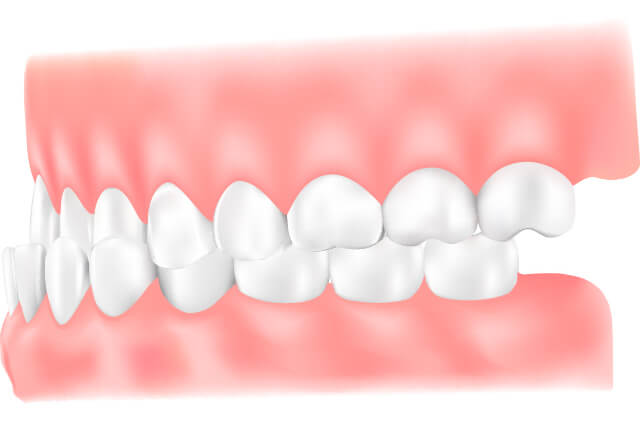 下顎前突（受け口・反対咬合）