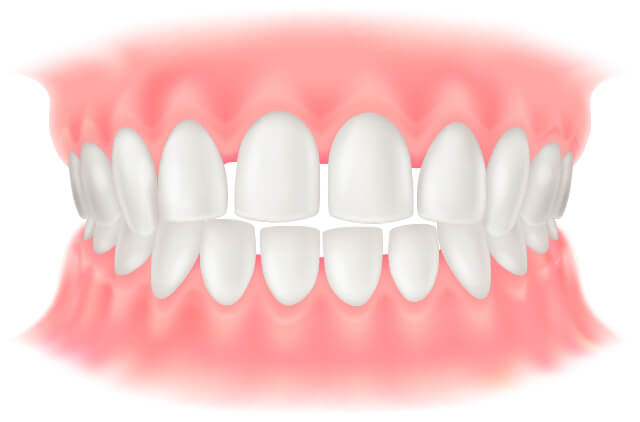 空隙歯列（すきっ歯）