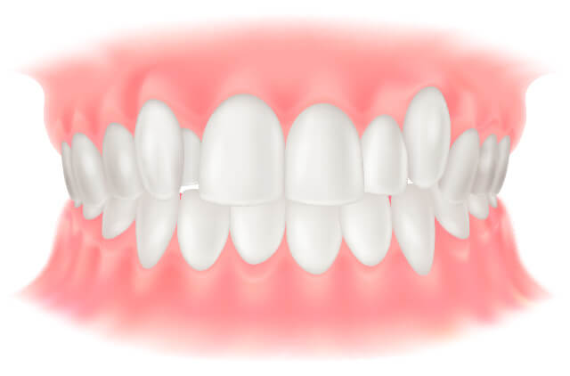 叢生（歯のガタガタ）
